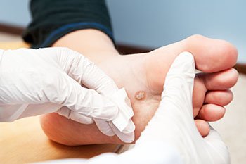 An Overview of Plantar Warts