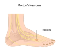 Causes and Symptoms of Morton’s Neuroma