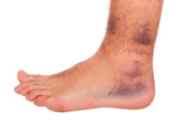 Ankle Sprains and Their Symptoms