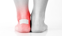 Blisters Can Be Caused by Excessive Friction