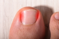 Can Ingrown Toenails Become Infected?