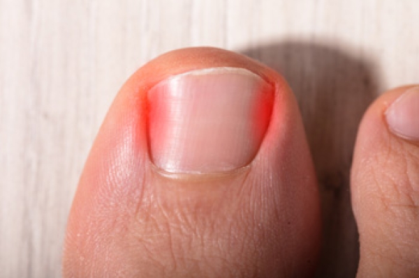 What Should I Do About My Ingrown Toenail?