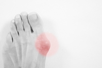 What Is Gout and Why Does It Occur?