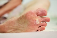 Two Types of Plantar Warts